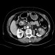 Subsegmental kidney infraction or focal nephritis: CT - Computed tomography